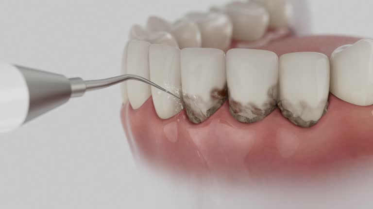 Trusted Teeth Cleaning And Checkup service in Artondale, WA - Dentist Open Now